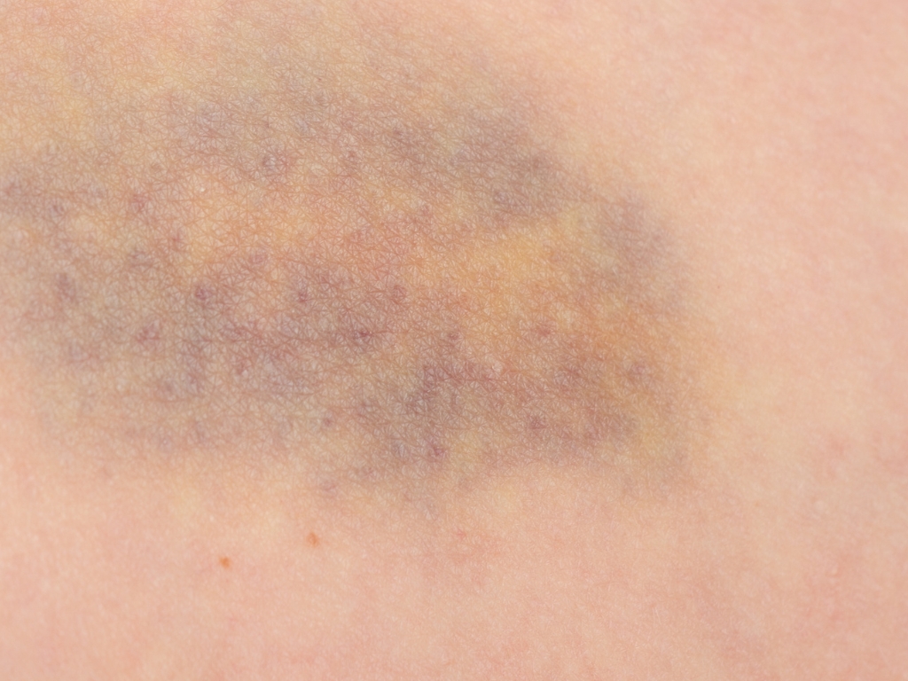 Livide Verf rbung Beispiele Und Ursachen Dermolex